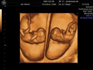3D/4D Scanning af baby som gravid